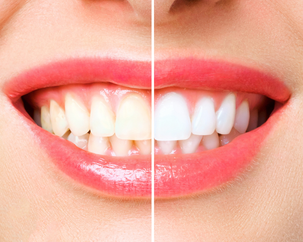 Natural White Teeth Whitening: Calm, Clean Routine